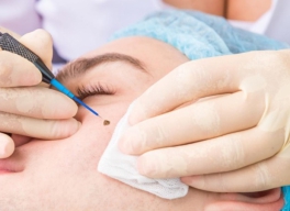 SAU KHI TẨY NỐT RUỒI NÊN LÀM GÌ, CHĂM SÓC DA NHƯ THẾ NÀO???