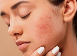 LOẠI VITAMIN NÀO TỐT CHO DA MỤN?