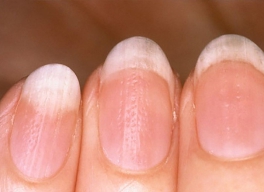 DẤU HIỆU BỆNH TRÊN MÓNG TAY BÁO HIỆU SỨC KHỎE CỦA BẠN