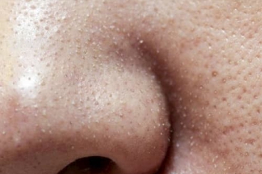 MỤN CÁM LÀ GÌ? NGUYÊN NHÂN VÀ CÁCH TRỊ MỤN CÁM HIỆU QUẢ NHẤT?