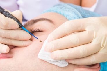 SAU KHI TẨY NỐT RUỒI NÊN LÀM GÌ, CHĂM SÓC DA NHƯ THẾ NÀO???