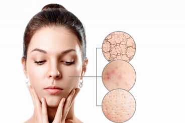 CÁCH NHẬN BIẾT VÀ CHĂM SÓC DA KHÔ VÀ DA HỖN HỢP