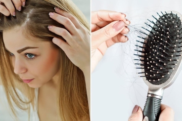 NGUYÊN NHÂN VÀ CÁCH KHÁC PHỤC RỤNG TÓC