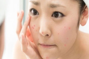 NẶN MỤN XONG CÓ NÊN ĐẮP MẶT NẠ? NHỮNG LƯU Ý CẦN LÀM SAU KHI NẶN MỤN.